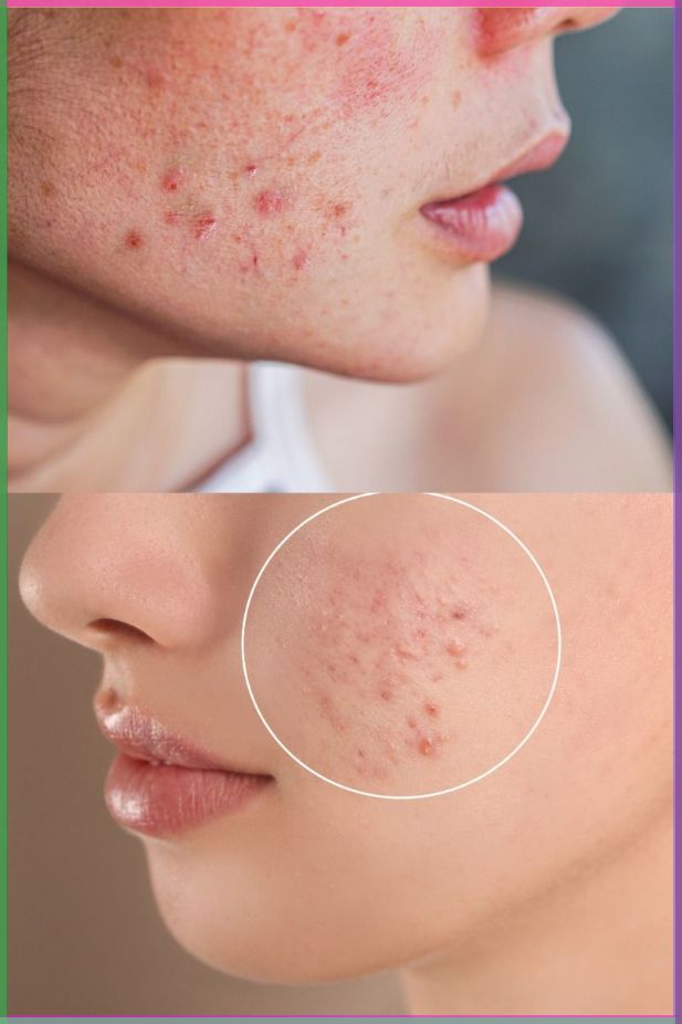 Vi-Sao-Dung-Retinol-Bi-Day-Mun--3.jpg