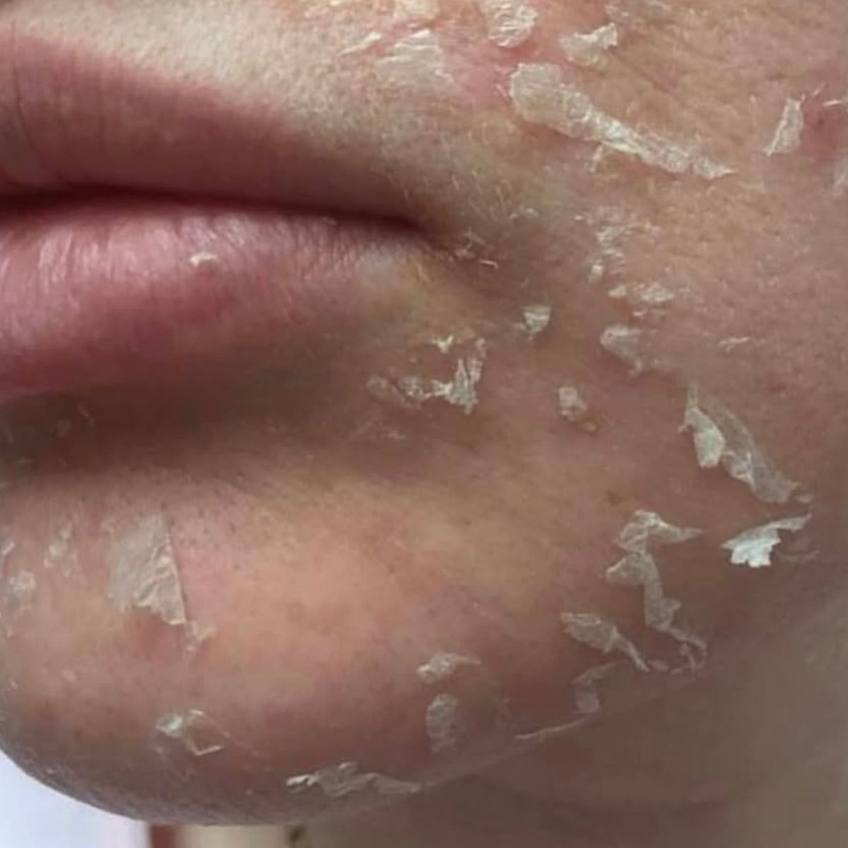 5-Sai-Lam-Khi-Dung-Tretinoin-Khien-Da-Mai-Khong-Cai-Thien.jpg