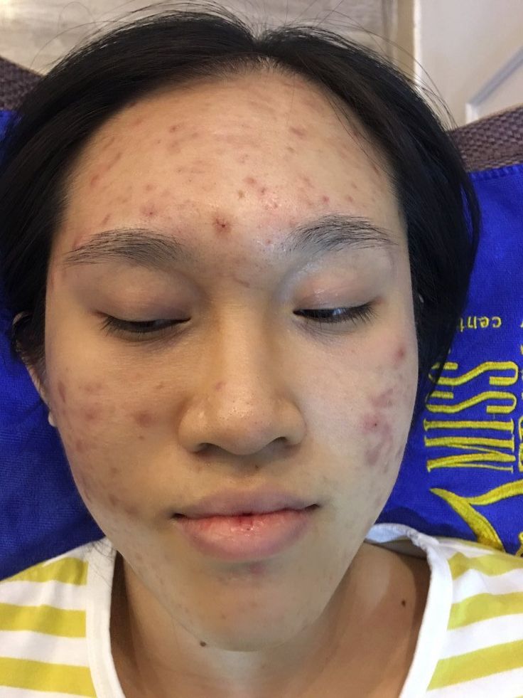 Chon-Sai-Spa-Lay-Nhan-Mun-Nguy-Co-Lay-Nhiem-Va-Seo-Ro-1.jpg
