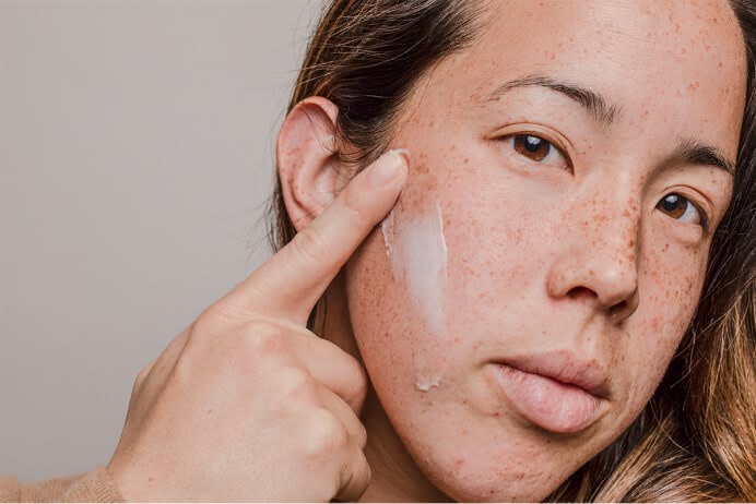 Dung-Tretinoin-Bi-Day-Mun-Binh-Thuong-Hay-Nguy-Hiem--1.jpg