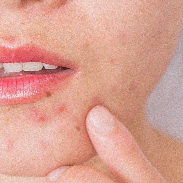 Nặn mụn bao lâu thì lành và cách chăm sóc giúp vết thương mau lành.jpg