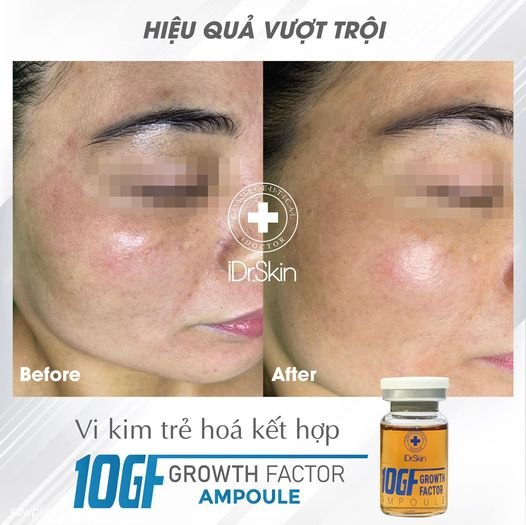 Tế bào gốc phục hồi da mỏng yếu iDr.Skin 10GF Growth Factor