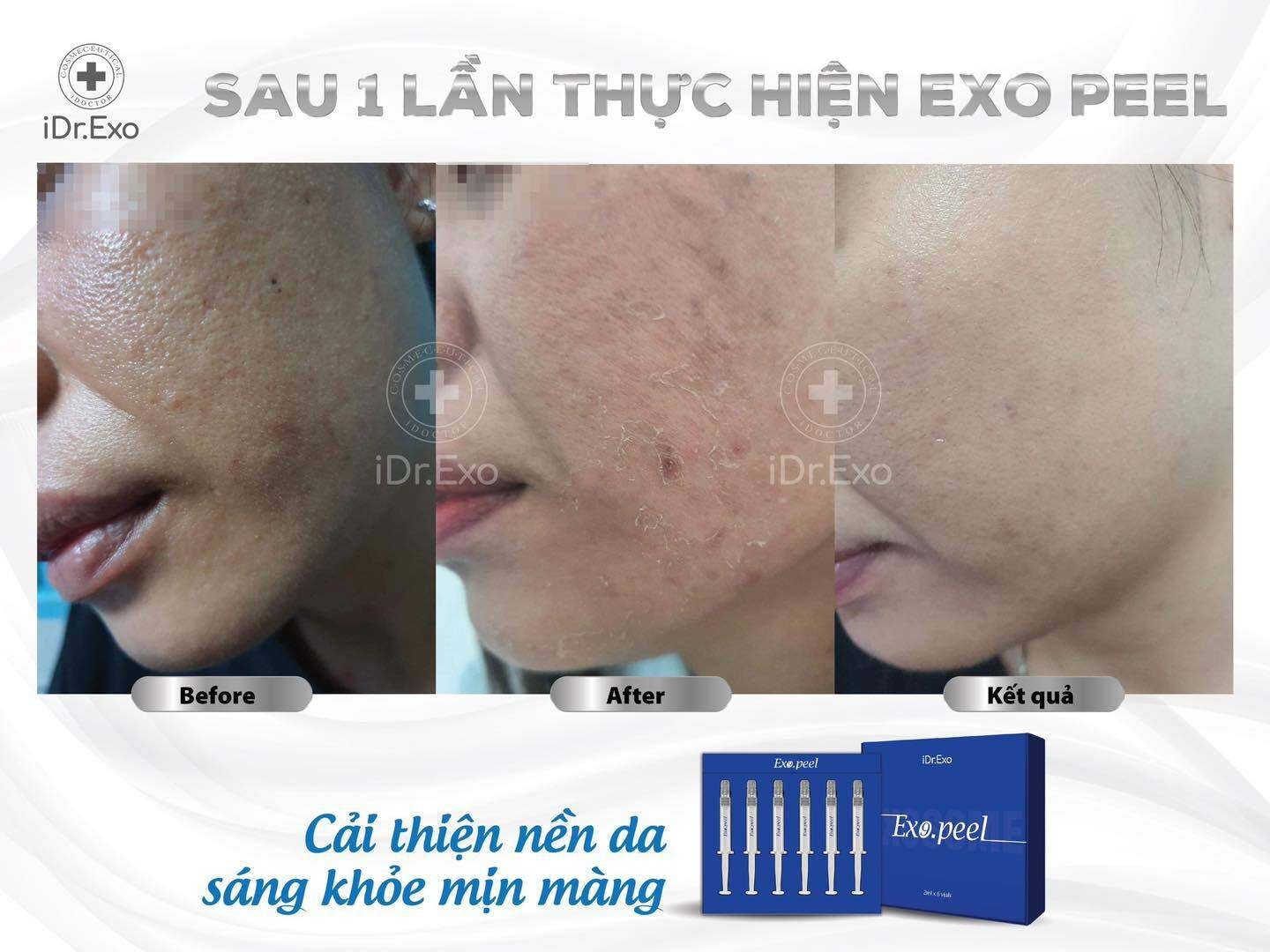 Peel da tái cấu trúc nền da khoẻ mạnh iDr.Exo Peel Idrskin