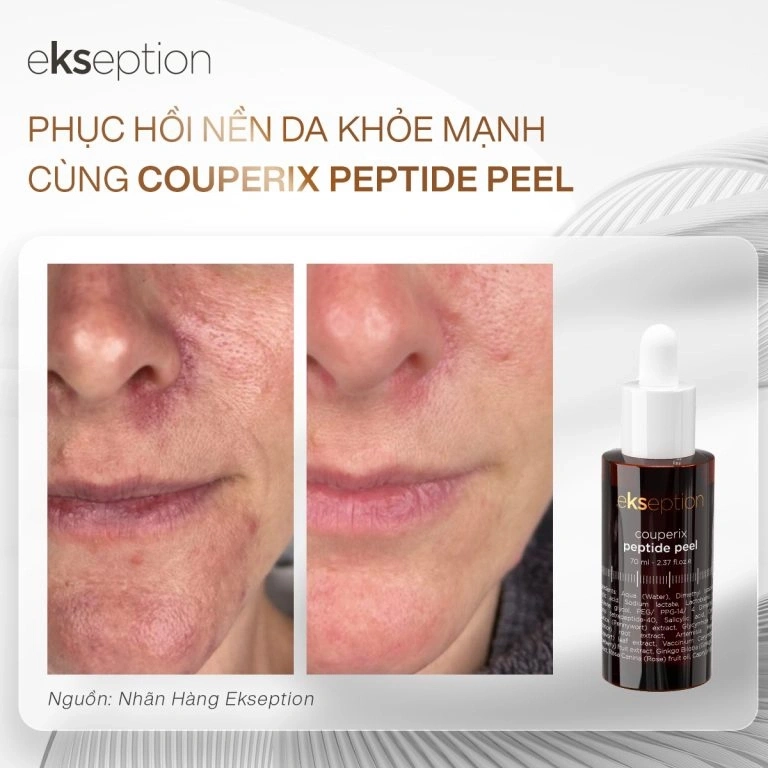 Tinh chất phục hồi da mỏng yếu Ekseption Couperix Peptide Peel