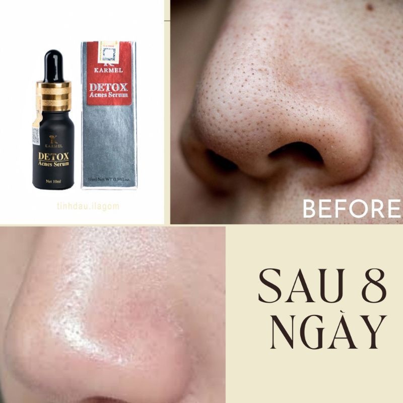 Serum loại bỏ mụn đầu đen bã nhờn dưỡng trắng da Detox Acnes Karmel