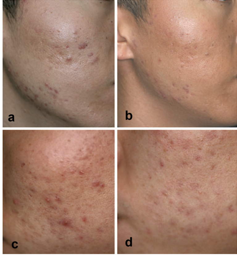 Peel da trị mụn ẩn thâm mụn Biomatrix M-Jessner 30 ml