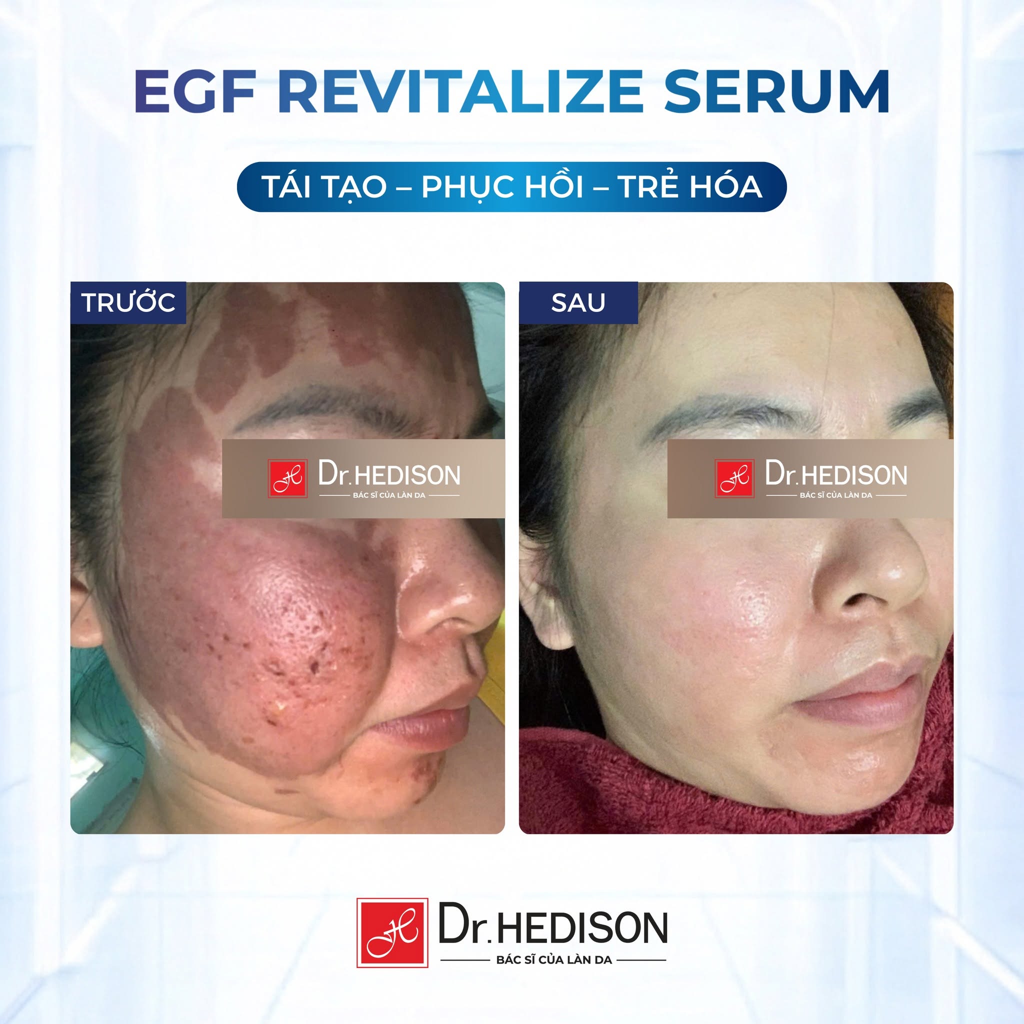 Huyết thanh phục hồi và dưỡng ẩm da Dr.HEDISON EGF Revitalize Serum