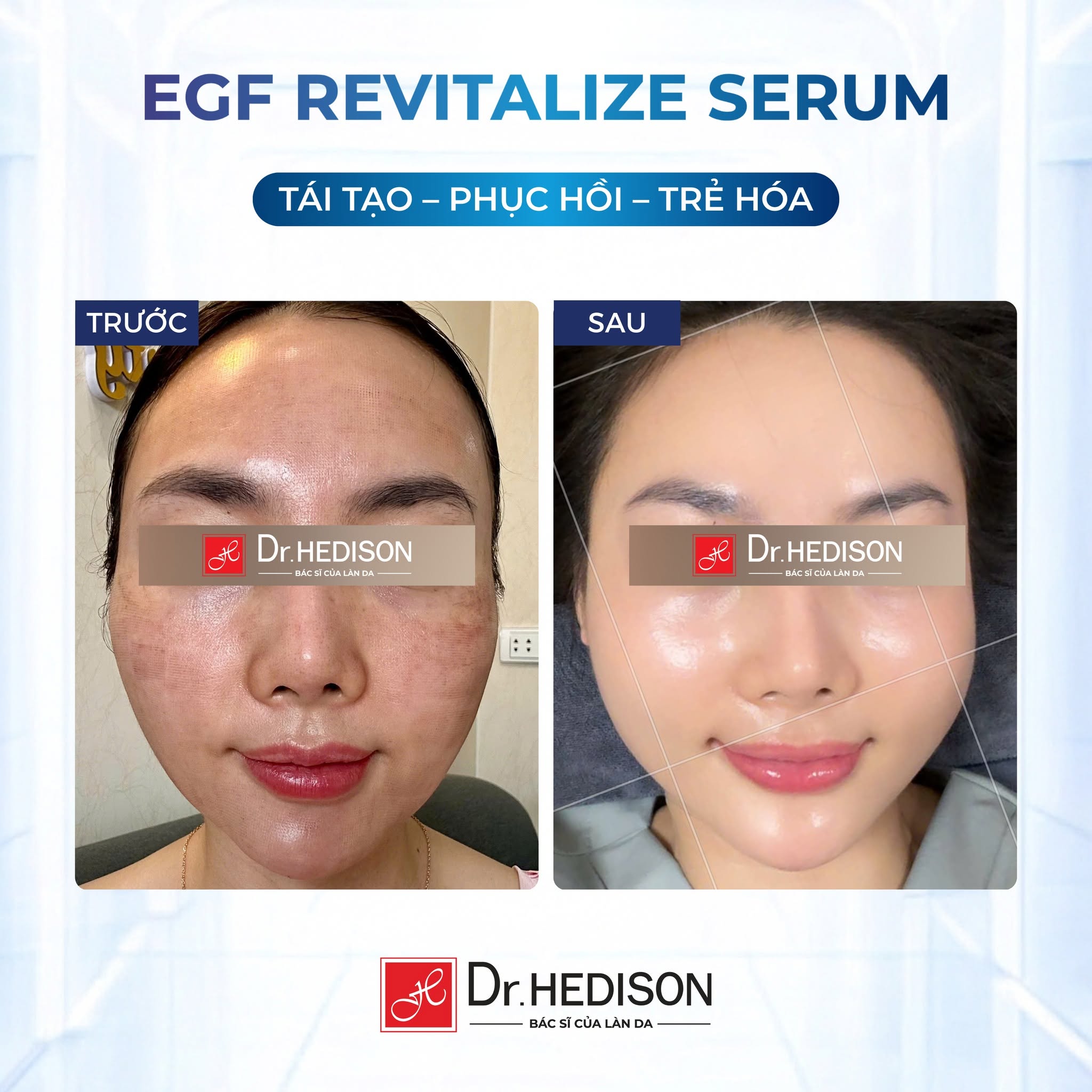 Huyết thanh phục hồi và dưỡng ẩm da Dr.HEDISON EGF Revitalize Serum
