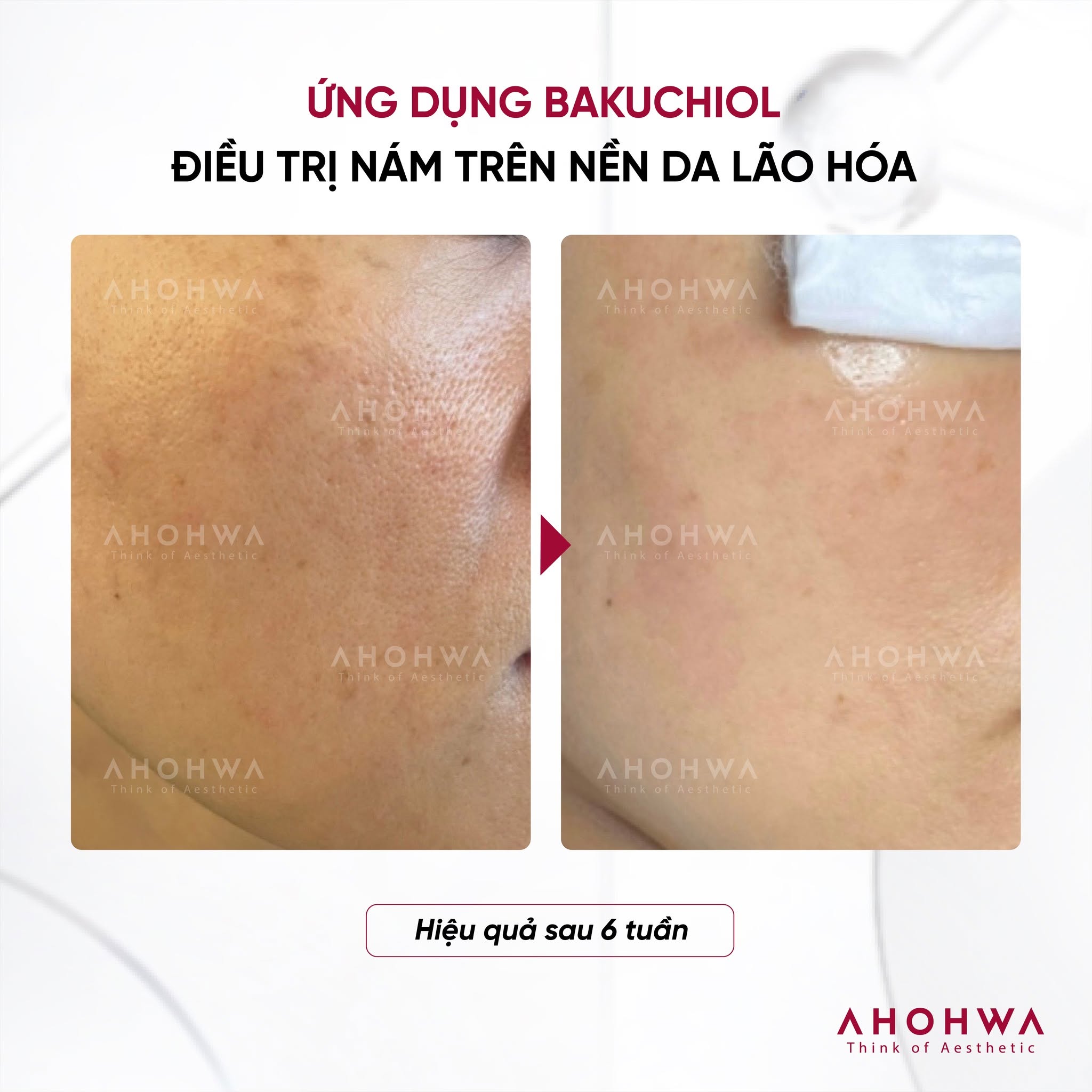 Kem dưỡng tái tạo trẻ hóa giảm nhăn Ahohwa Bakuchiol Cream