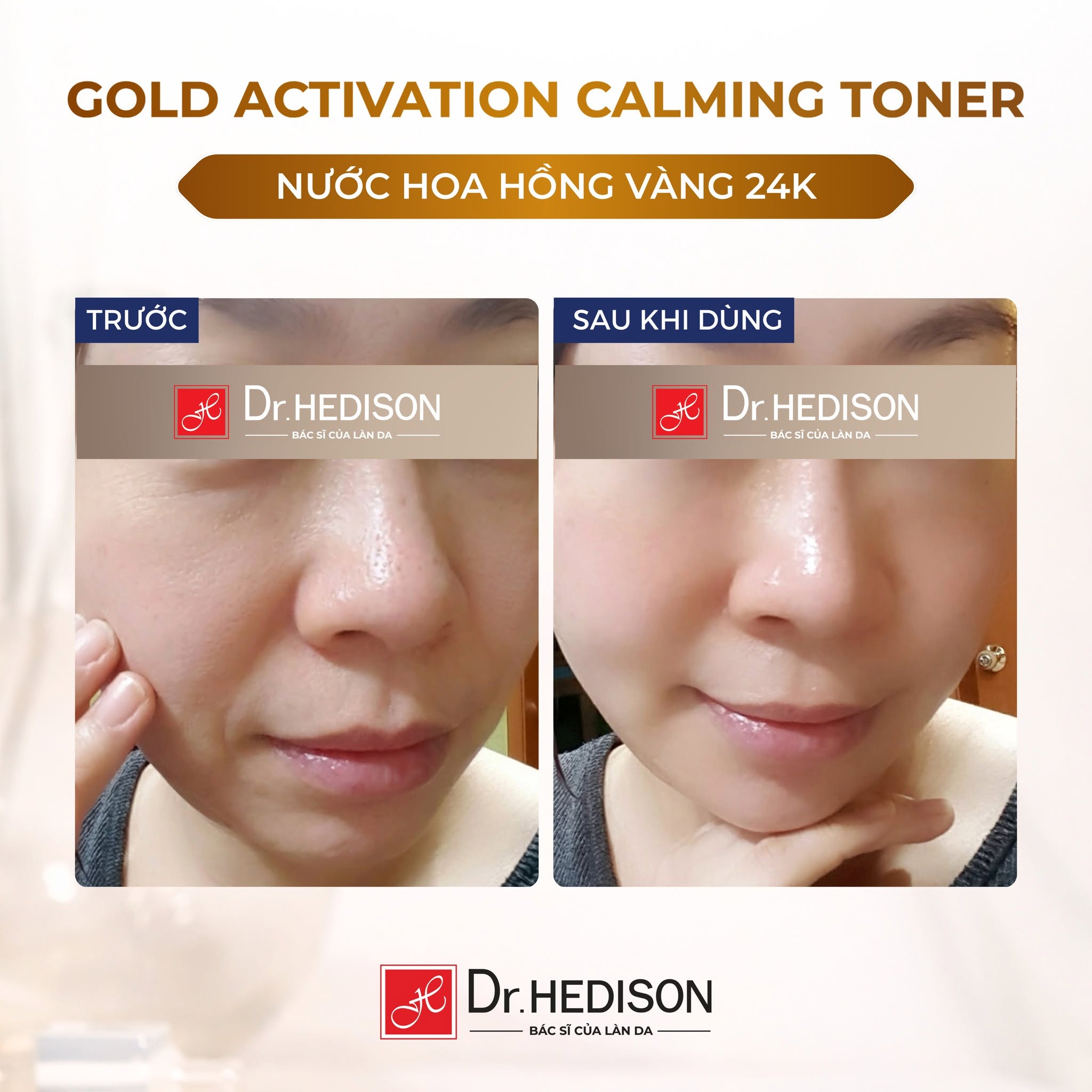 Nước hoa hồng tinh chất vàng Dr.HEDISON Gold Activation Calming Toner