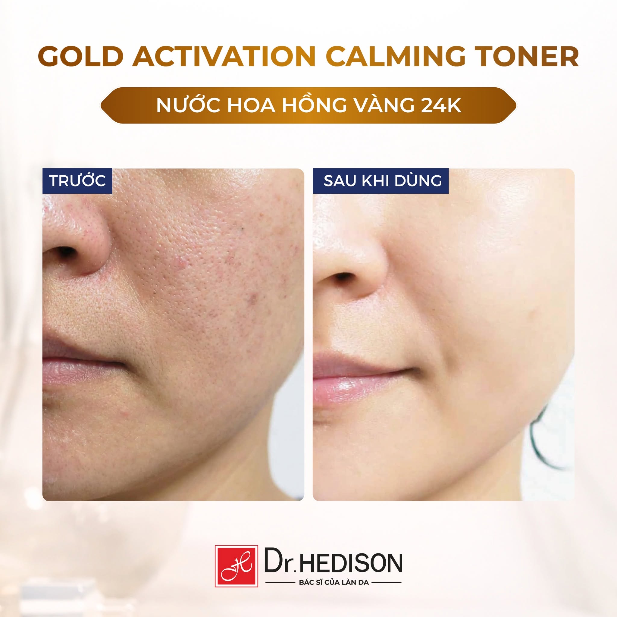 Nước hoa hồng tinh chất vàng Dr.Hedison Gold Activation Calming Toner (150ml-500ml)