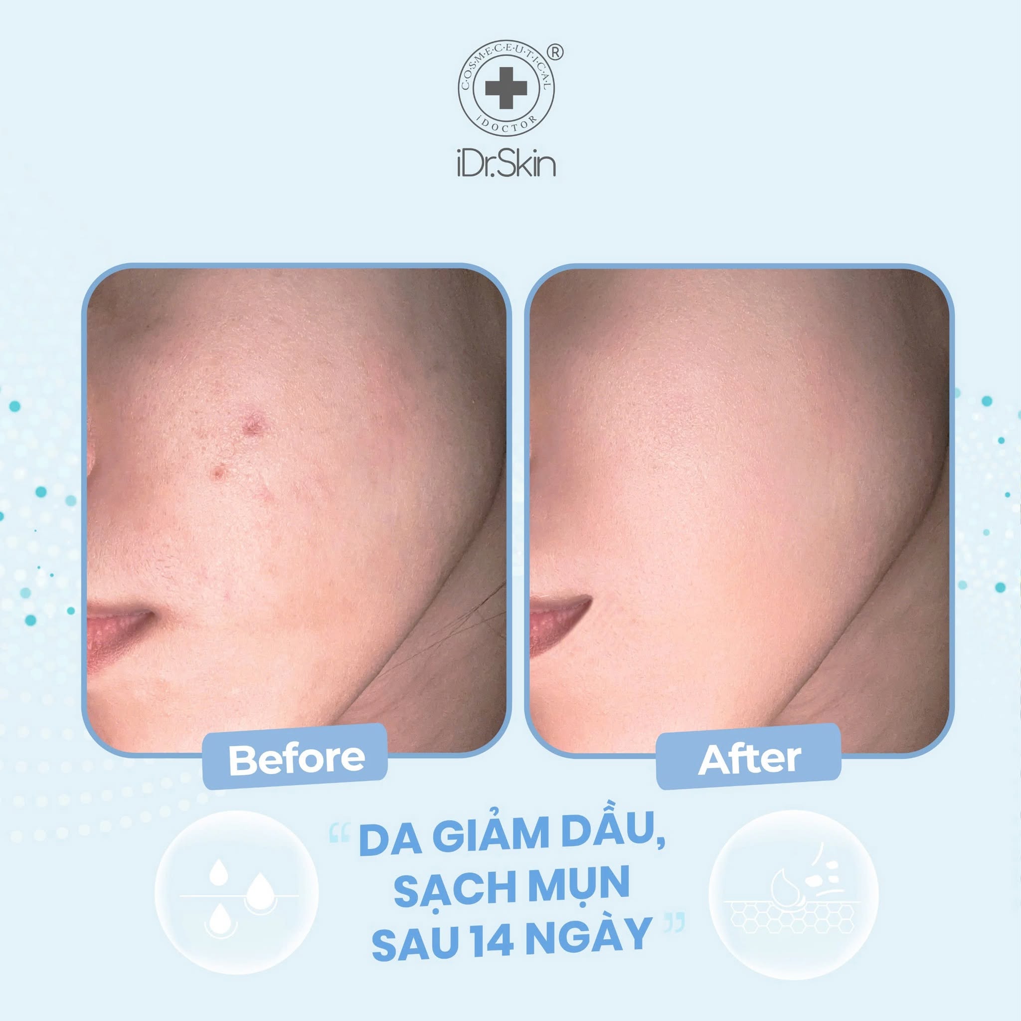 Sữa rửa mặt cho da dầu mụn sạch sâu iDr.Skin Facial Cleansing