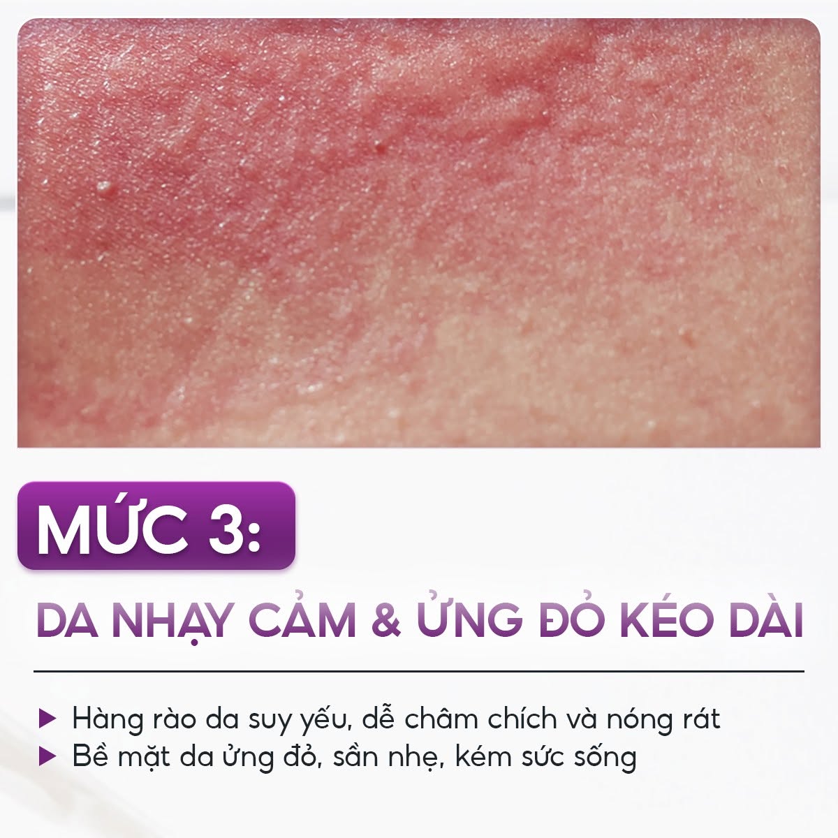 Tinh chất vial giữ ẩm làm mờ nếp nhăn ngăn ngừa sẹo SkinClinic Hyaluronic Acid 3,5%