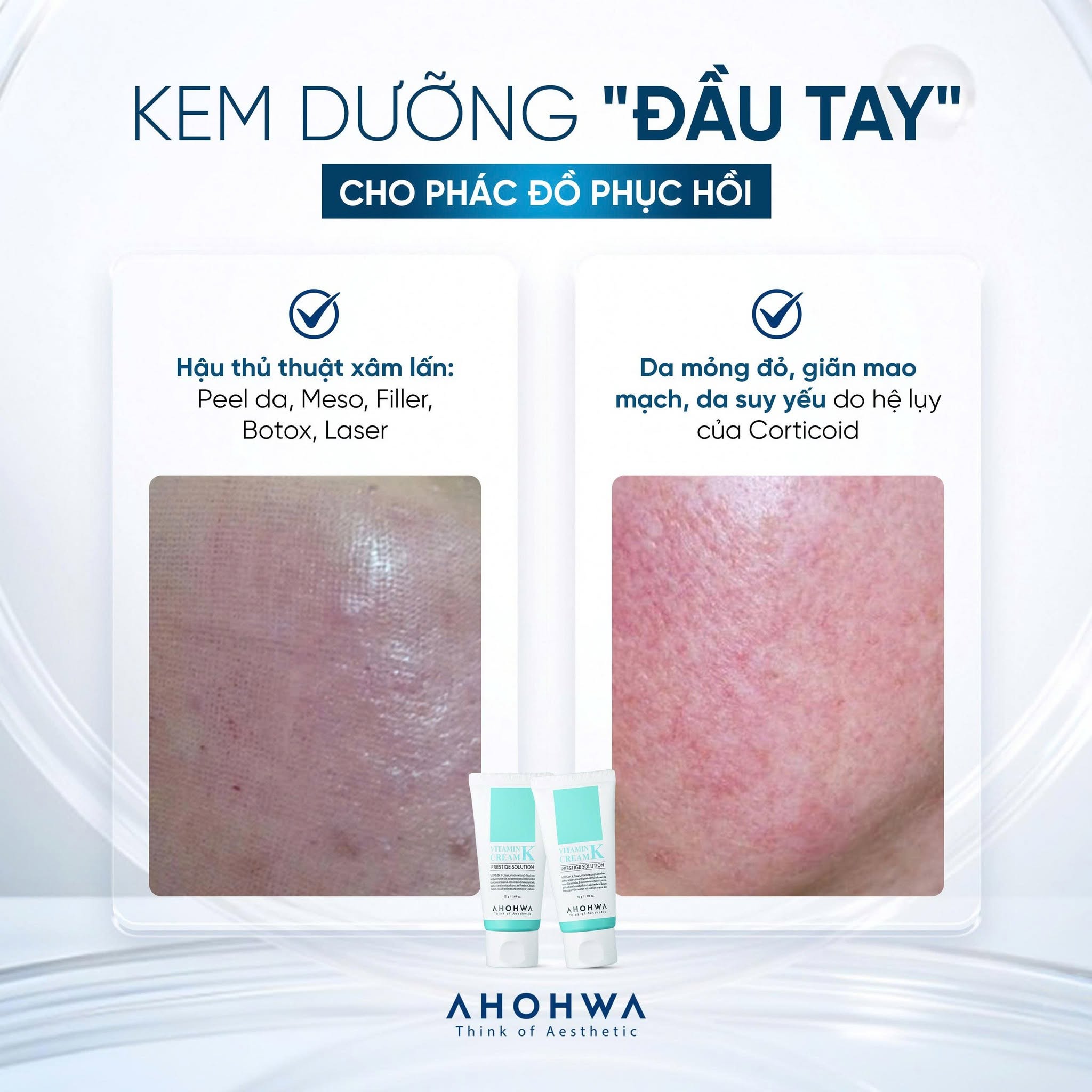 Kem phục hồi da giãn mao mạch da nhiễm corticoid Ahohwa Prestige Solution Vitamin K Cream 3.jpg