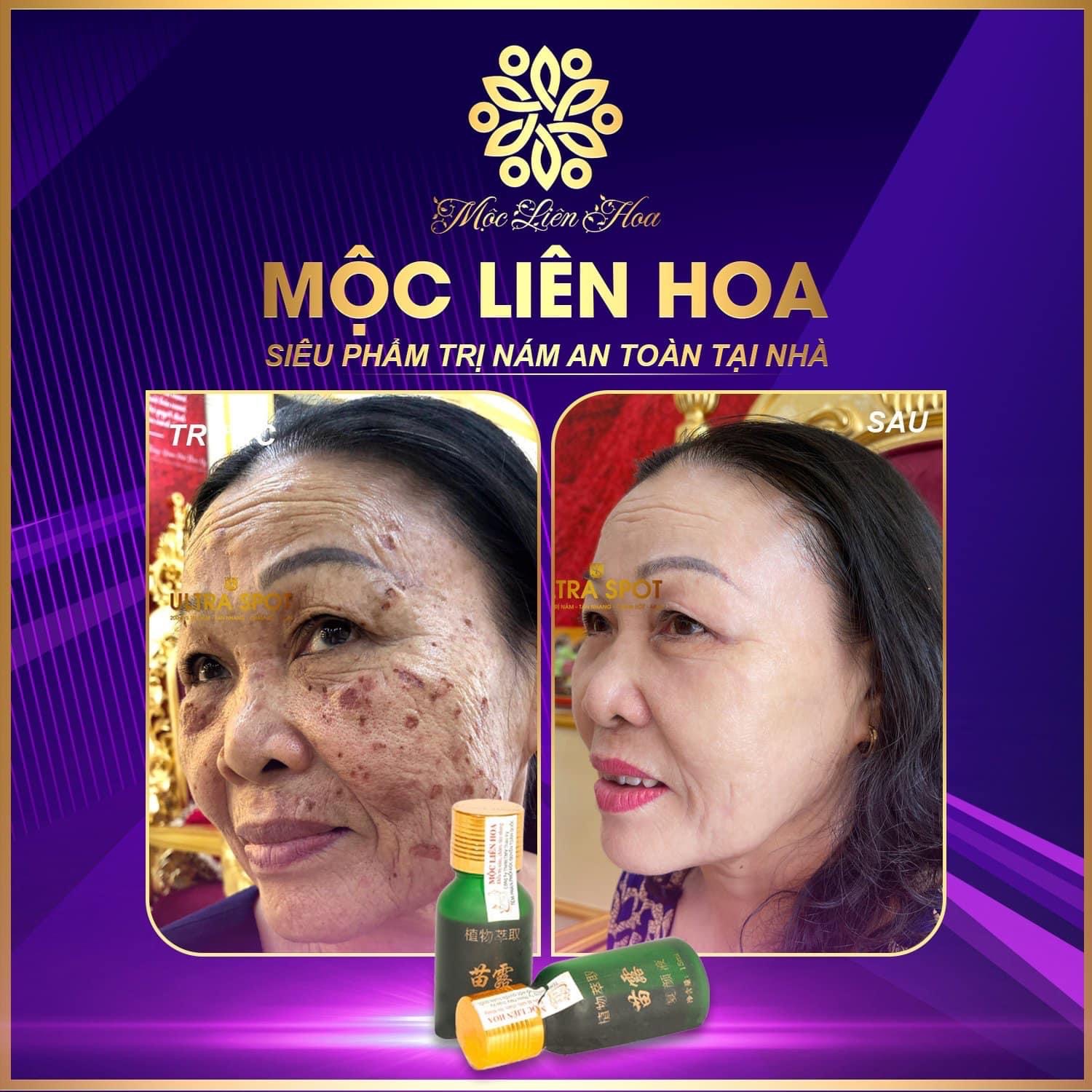 Tinh-chat-Moc-Lien-Hoa-Ultra-Spot-mo-nam-tan-nhang_Tinh chất Mộc Liên Hoa Ultra Spot mờ nám, tàn nhang 3.jpg