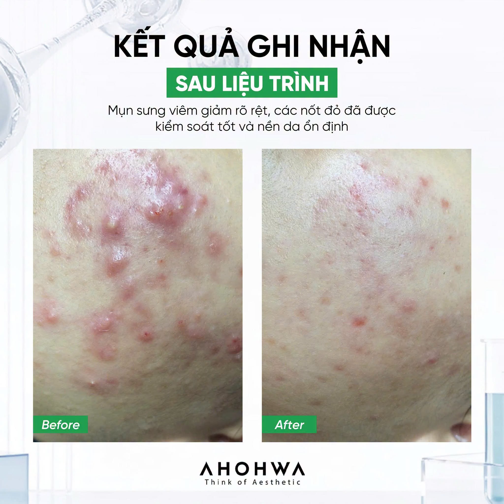 Tinh chất chấm mụn hạn chế viêm Ahohwa Acless Solution Control Clear Spot 6.jpg