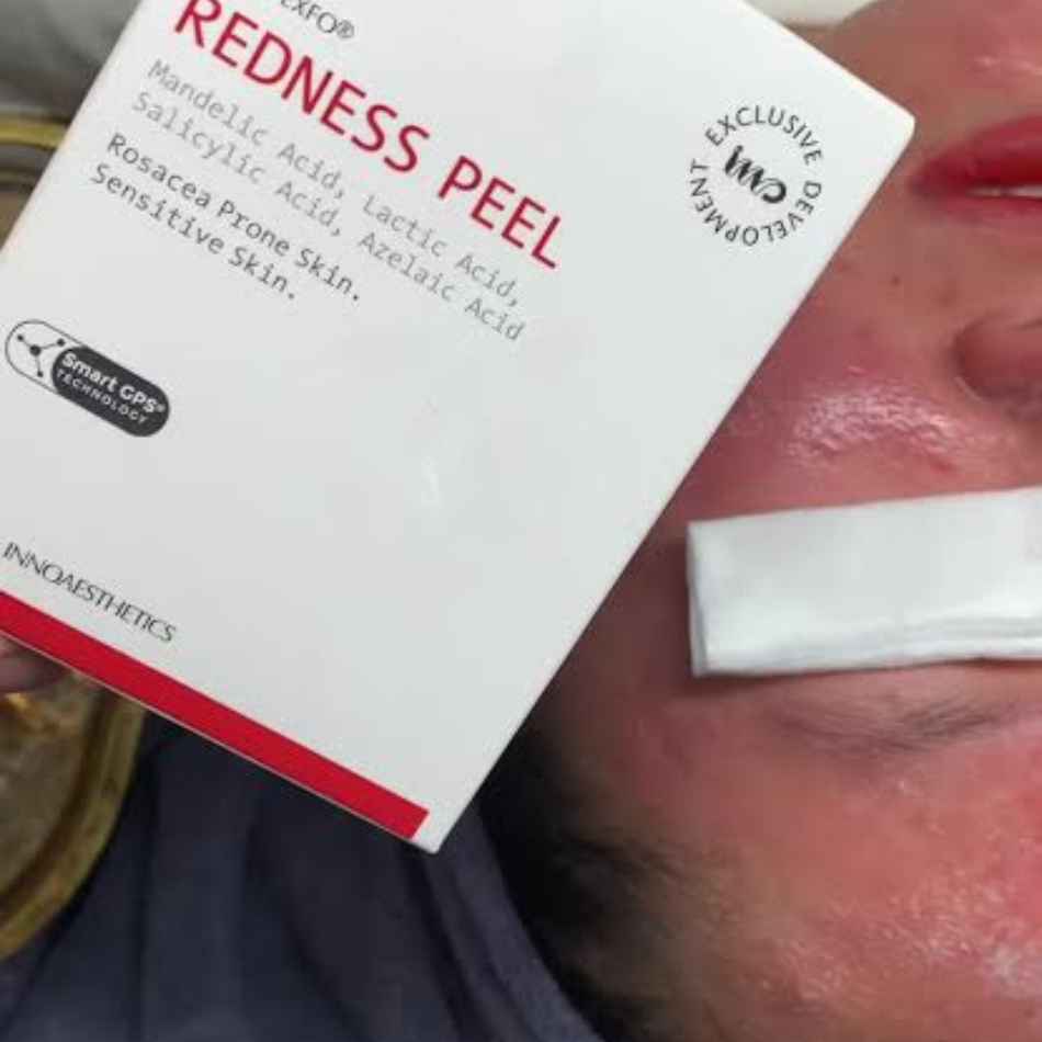 Tinh chất peel da nhạy cảm mỏng yếu phục hồi thải độc da Innoaesthetics REDNESS PEEL (nguyên hộp).jpg
