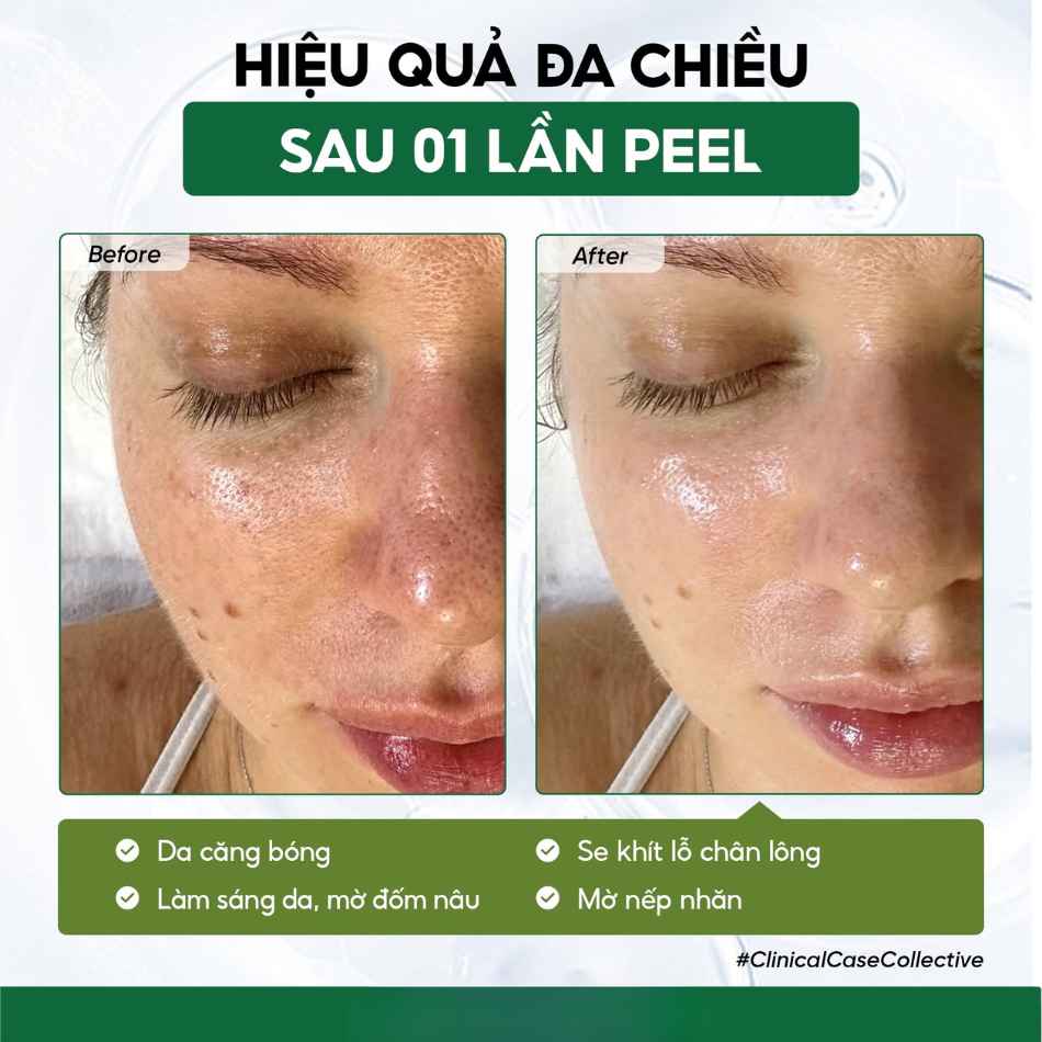 Tinh chất peel tái tạo phục hồi da Innoaesthetics MCA 35 (1).jpg