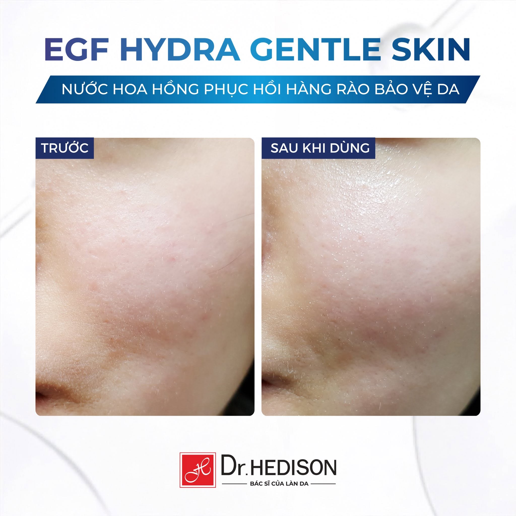 Toner cấp ẩm, làm dịu da tái tạo tế bào gốc Dr.HEDISON EGF Hydra Gentle Skin 1.jpg