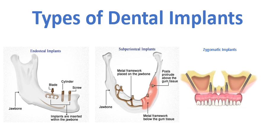 CÁC LOẠI IMPLANT NHA KHOA.