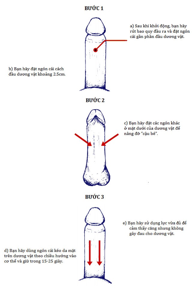 Kỹ thuật Backward Puller