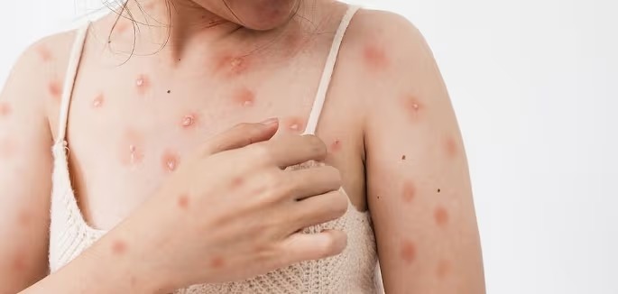 Nguy cơ mắc các bệnh truyền nhiễm nguy hiểm