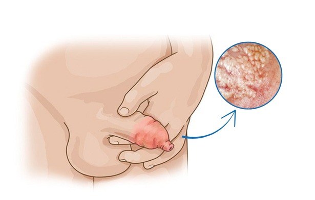 Do viêm bao quy đầu