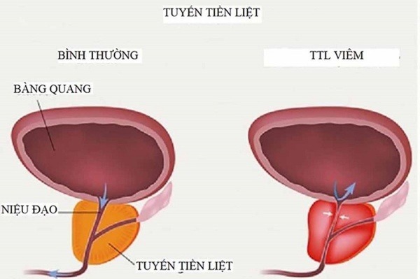 Do viêm tuyến tiền liệt