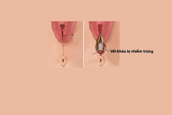 Khiến vết khâu tầng sinh môn khó lành
