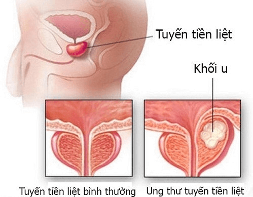 Nguy cơ ung thư tiền liệt tuyến
