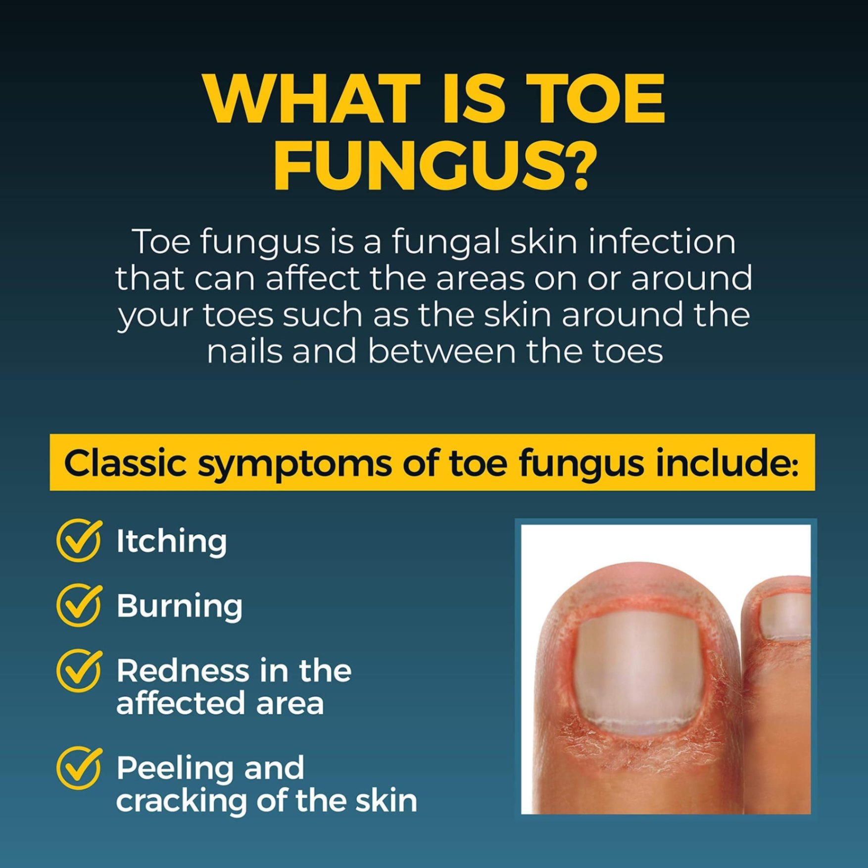 Fungi Nail Maximum Strength Anti-Fungal Liquid - Dung Dịch Diệt Nấm Móng Hiệu Quả