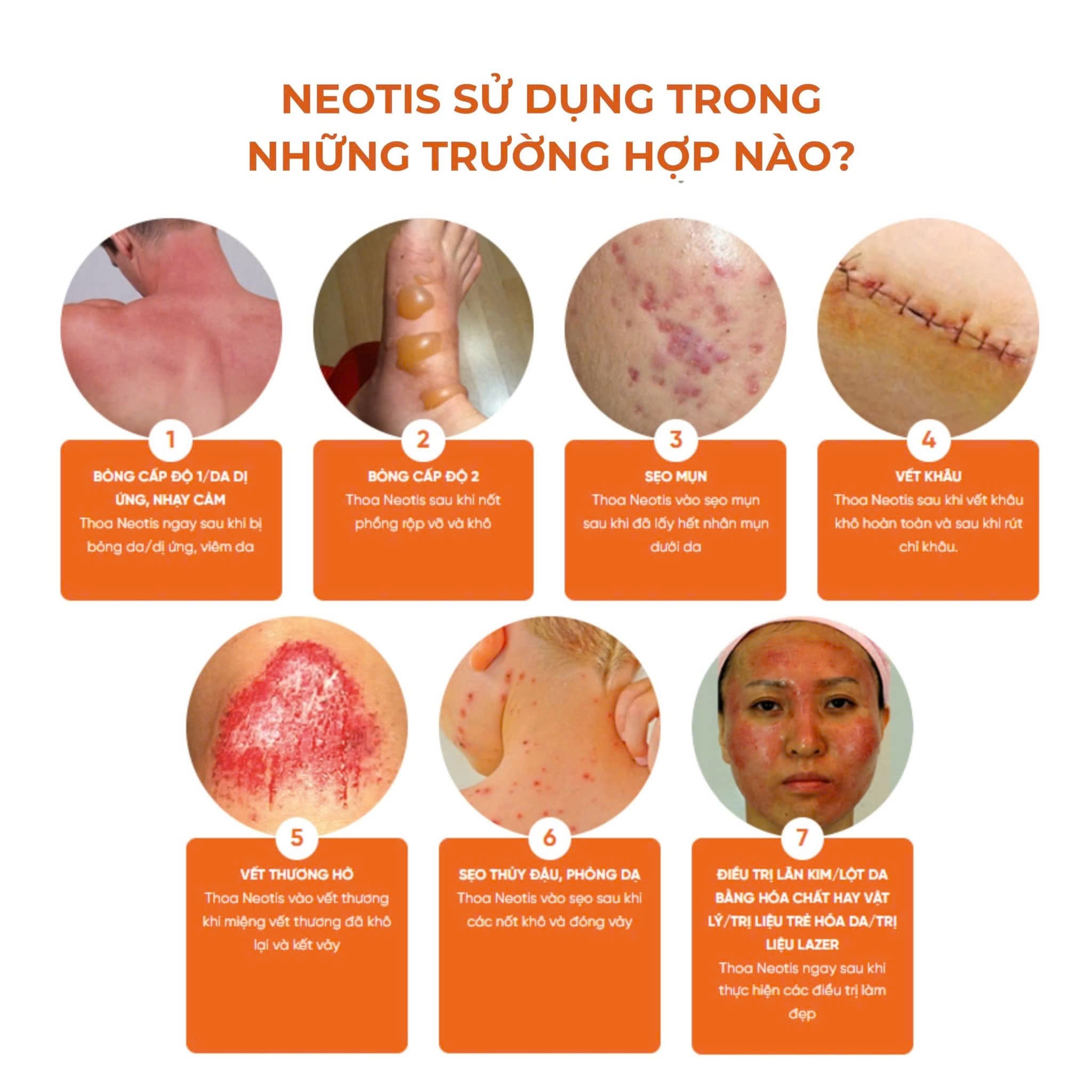 KEM TRỊ THÂM MỤN - TRỊ SẸO - PHỤC HỒI DA NEOTIS HÀN QUỐC, 30G