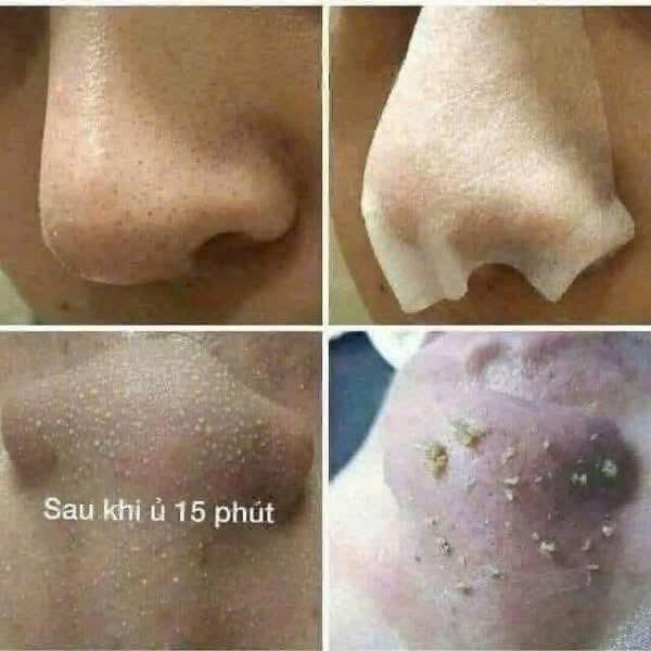 DUNG DỊCH Ủ MỤN ĐẦU ĐEN