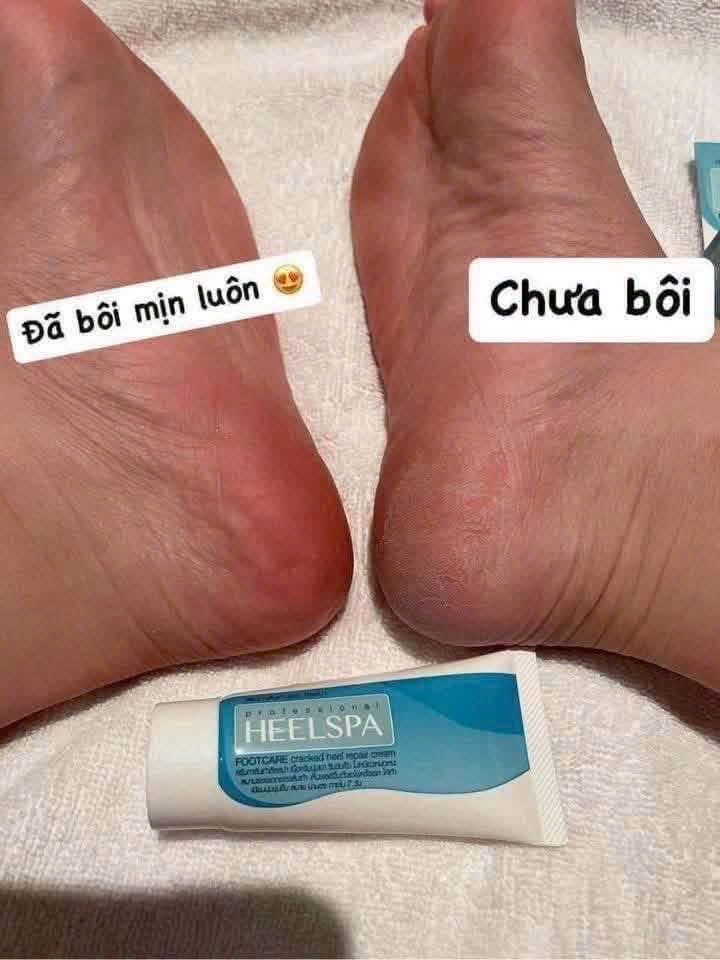 KEM TRỊ NỨT CHÂN