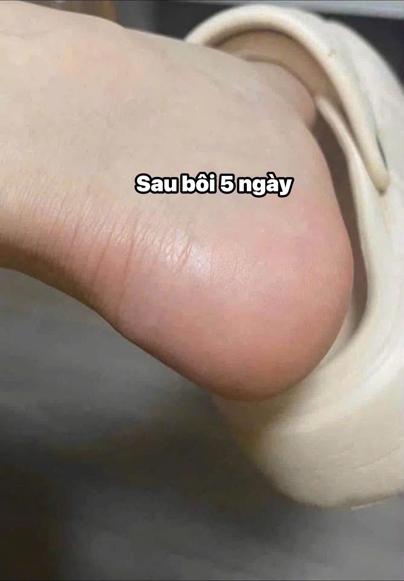 KEM TRỊ NỨT CHÂN