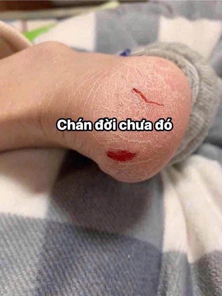 KEM TRỊ NỨT CHÂN