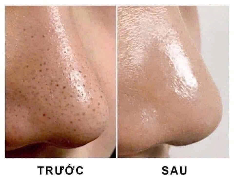 DUNG DỊCH Ủ MỤN ĐẦU ĐEN PICK HÀN