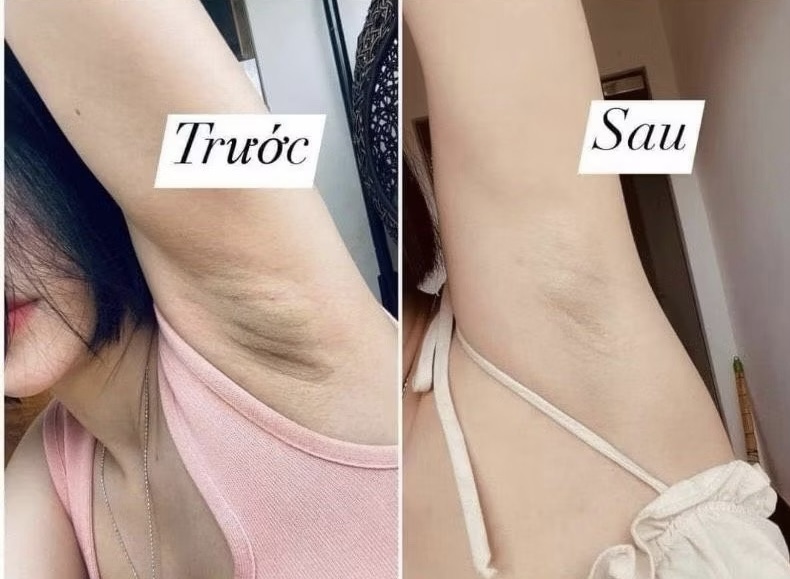 KEM TRỊ THÂM THÁI LAN S88