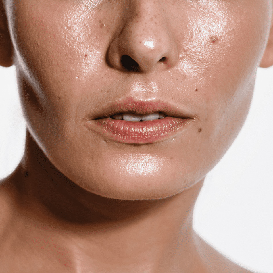Niacinamide – Bí quyết kiểm soát dầu nhờn hiệu quả cho làn da bóng dầu