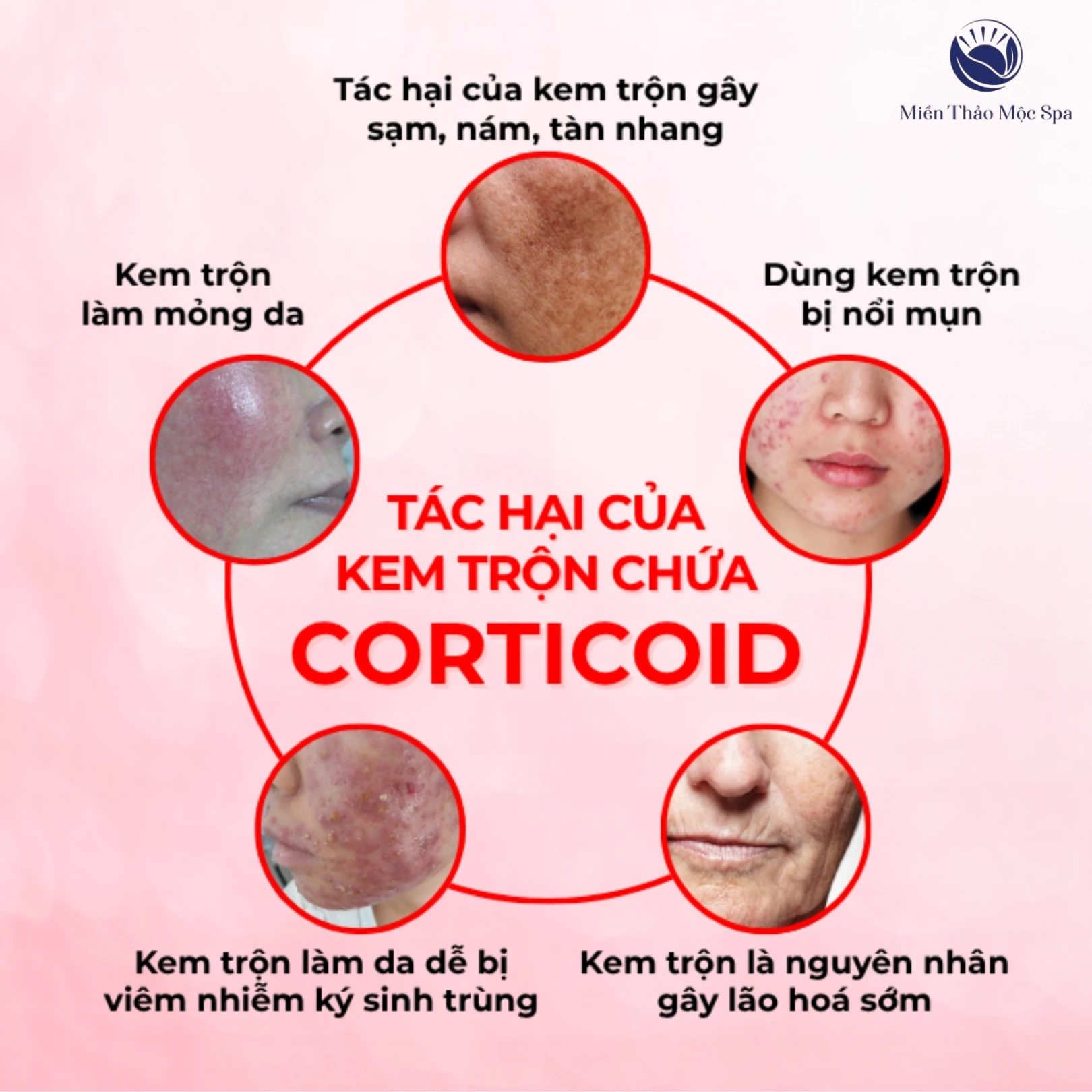 Tac hai cua kem tron chua Corticoid.webp
