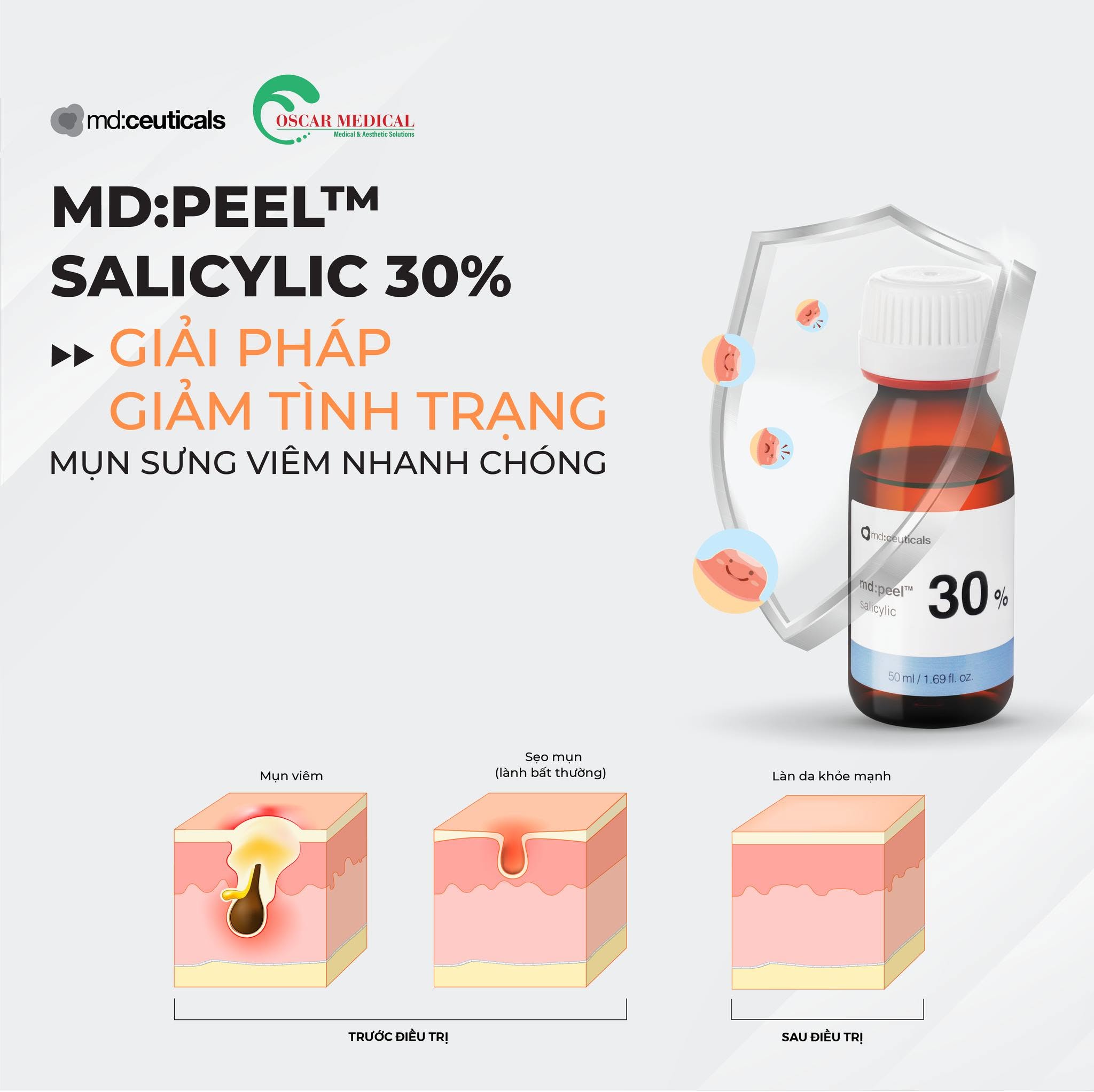 Dung dịch peel loại bỏ mụn sưng viêm cấp độ 3,4.jpg