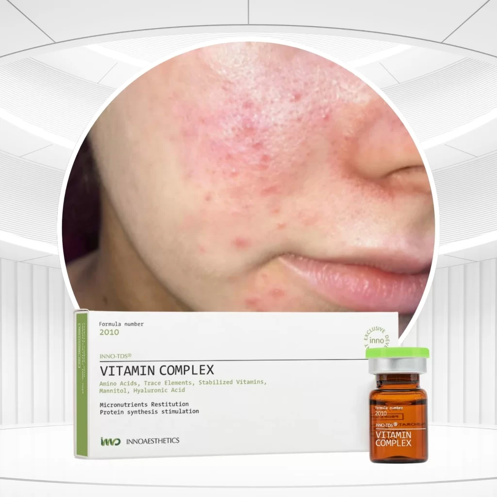 Hoạt chất meso phục hồi da Innoaesthetics VITAMIN COMPLEX (tách lẻ).webp