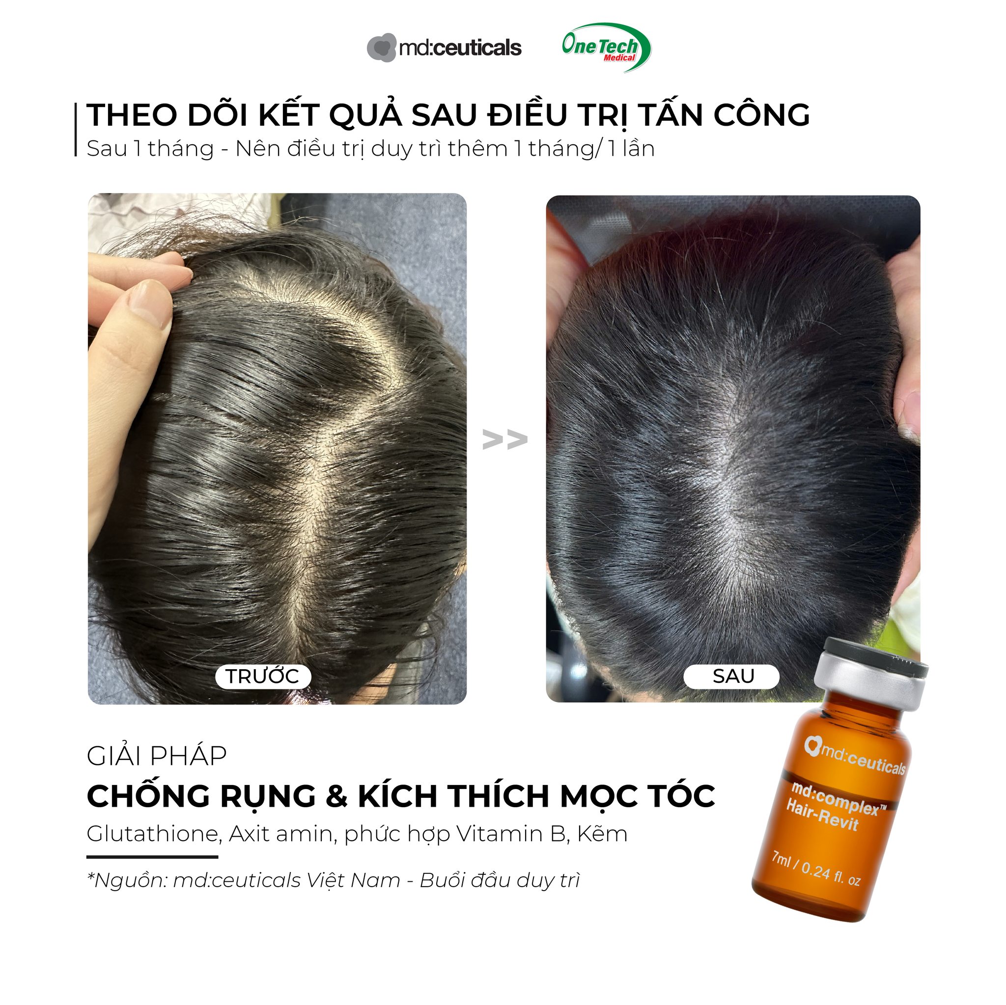 Meso-chong-rung-toc-amp-Kich-thich-moc-toc-Md-Complex-Hair-Revit-MD-Ceuticals-7ml_Meso chống rụng tóc &.jpg