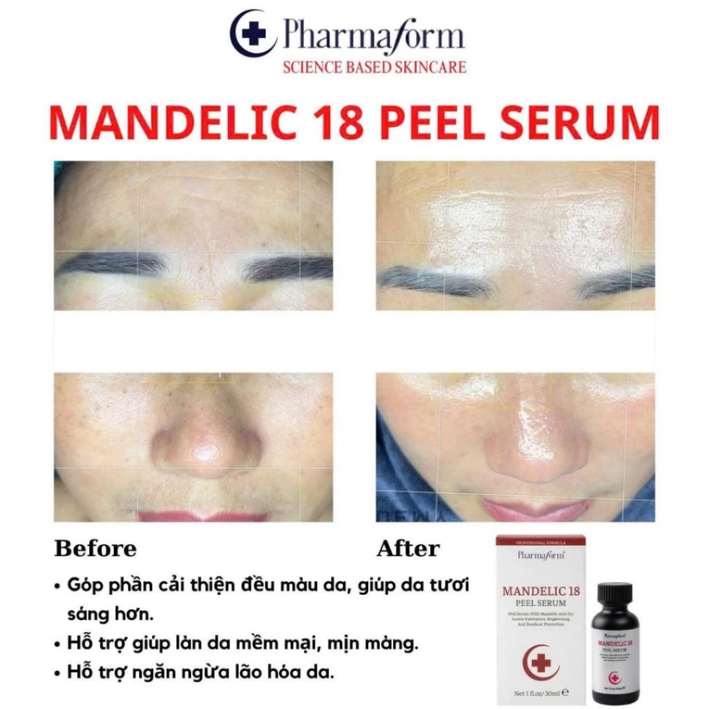 Tinh chất hỗ trợ chăm sóc da thông thoáng lỗ chân lông Pharmaform Mandelic 18 Peel Serum.jpg