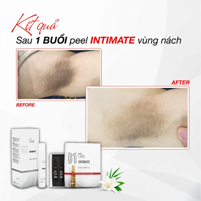 Tinh chất peel chống oxy hóa cho khu vực vùng kín Innoaesthetics INTIMATE 01 (tách lẻ).webp