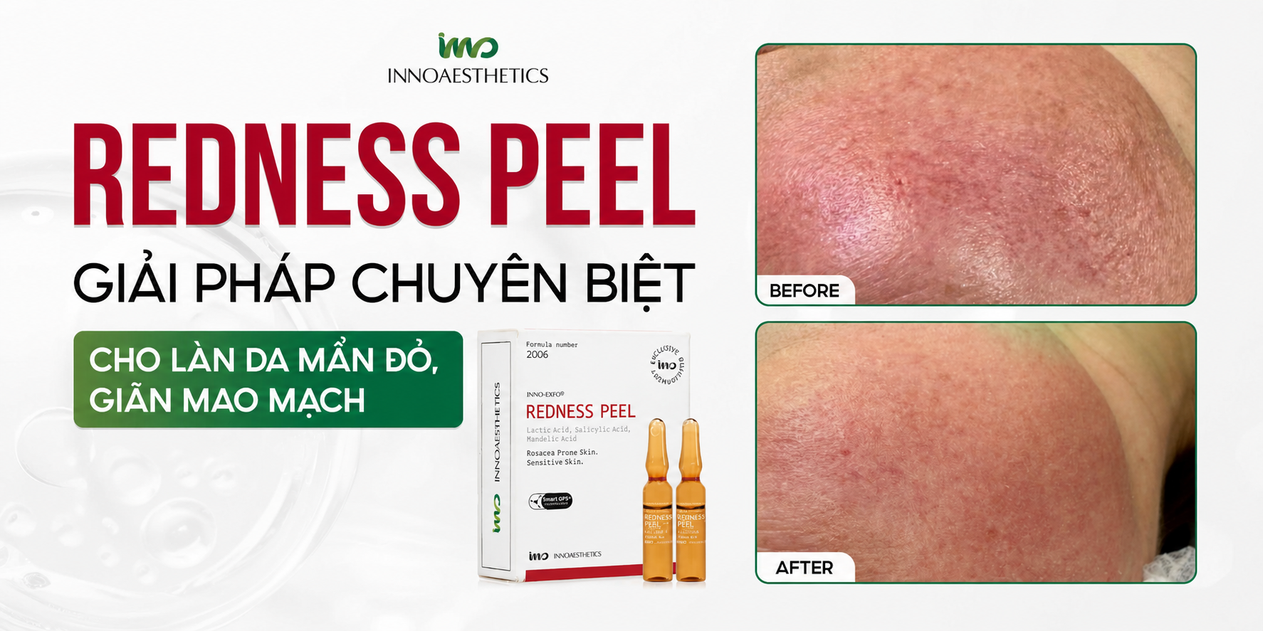 Innoaesthetics REDNESS PEEL – Hoạt Chất Peel Cho Da Mỏng Yếu, Nhạy Cảm, Dễ Mẩn Đỏ.png