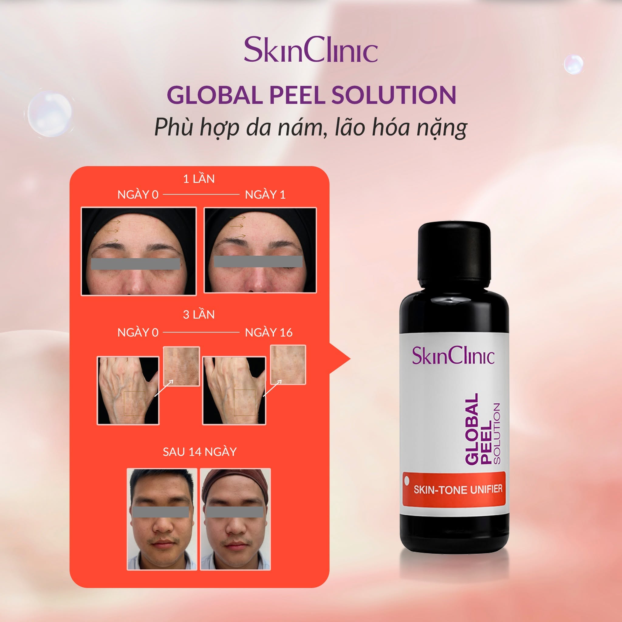 Tinh chất peel không bong cải thiện đốm nám đồng nhất màu da SkinClinic Global Peel Solution.jpg