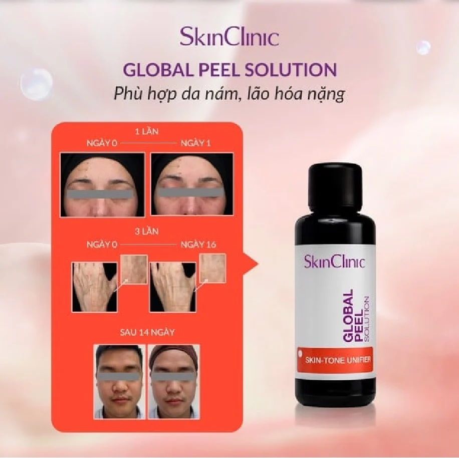 Tinh chất peel không bong cải thiện đốm nám đồng nhất màu da SkinClinic Global Peel Solution.webp