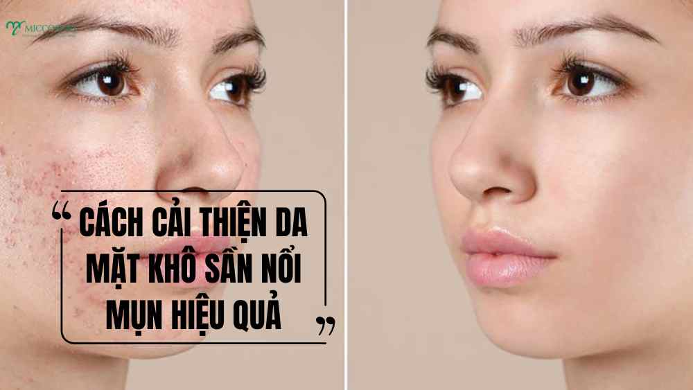 Top 6 nguyên nhân thường gặp ở da mặt khô sần nổi mụn