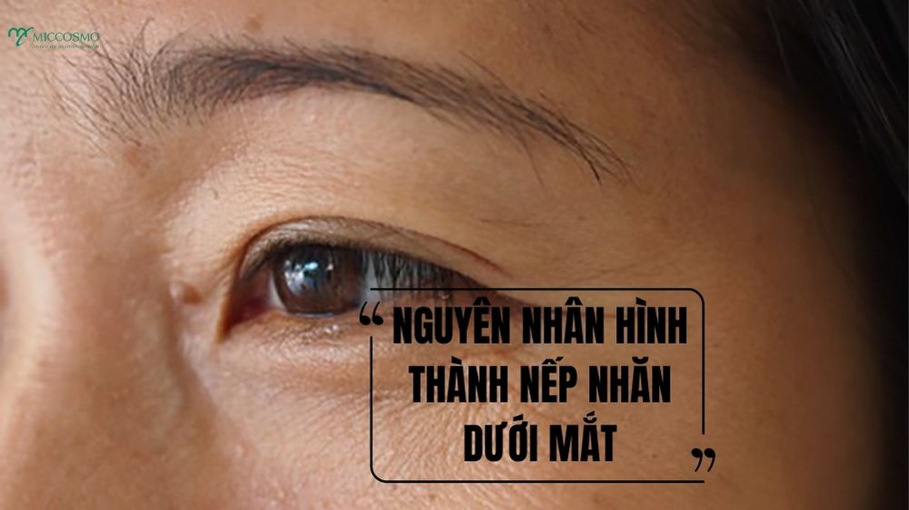 Vi-sao-mat-de-xuat-hien-nep-nhan.jpg